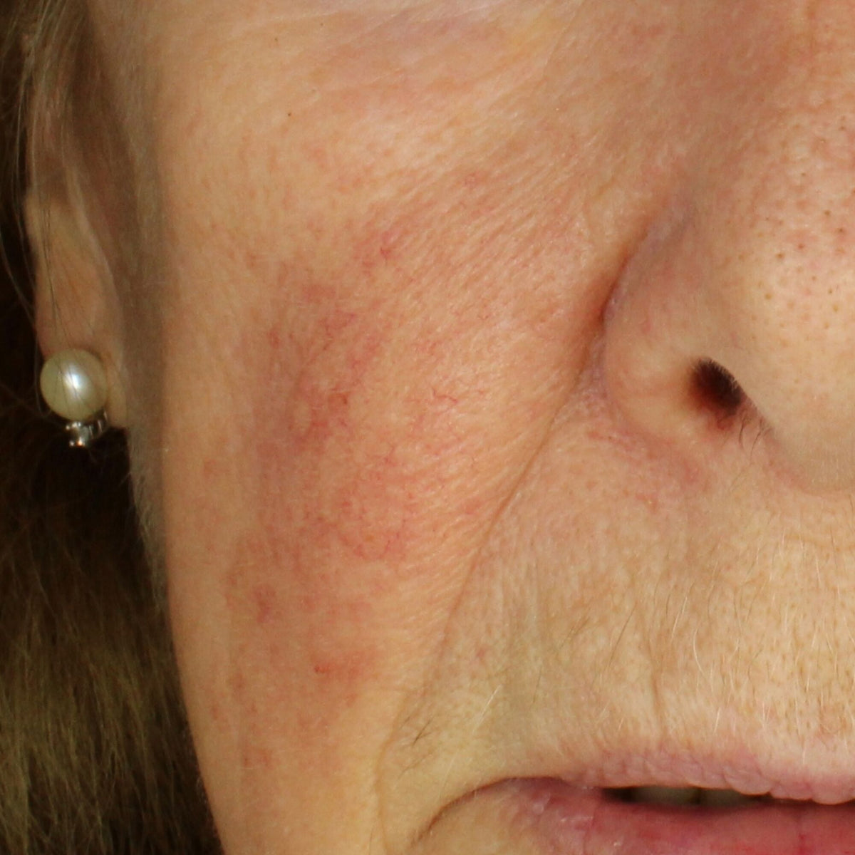 HAPPY_FACE_AZELAIC ACID AFTER (1)_WEB