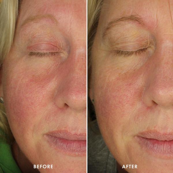 happy_face_azelaic_acid_skin_clearing_gel_cream_194987_clinical_trial_before_after_2_WEB